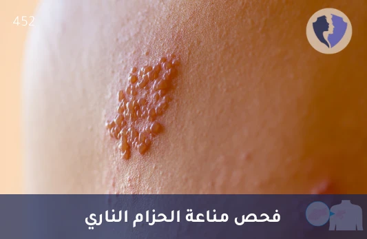 فحص مناعة الحزام الناري - تحليل الأجسام المضادة لفيروس النطاقي الحماقي (Herpes Zoster IgG)