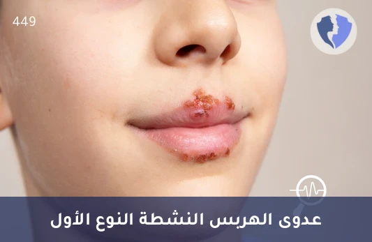 فحص الهربس البسيط النشط - تحليل الأجسام المضادة لفيروس الهربس البسيط النوع الأول (HSV I IgM)