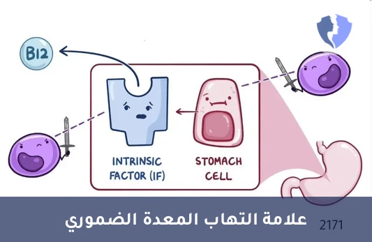 فحص خلايا المعدة المناعي - تحليل الأجسام المضادة للخلايا الجدارية (APCA)