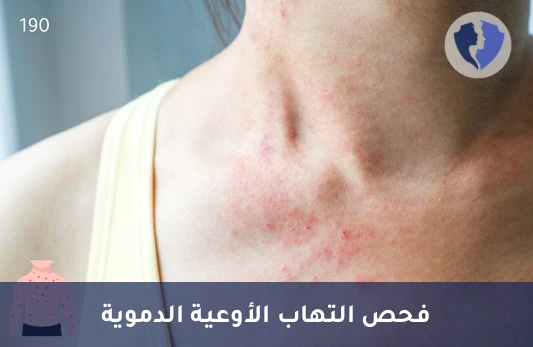 فحص التهاب الأوعية الدموية - تحليل الأجسام المضادة للسيتوبلازم في العدلات (PR3 c-ANCA)