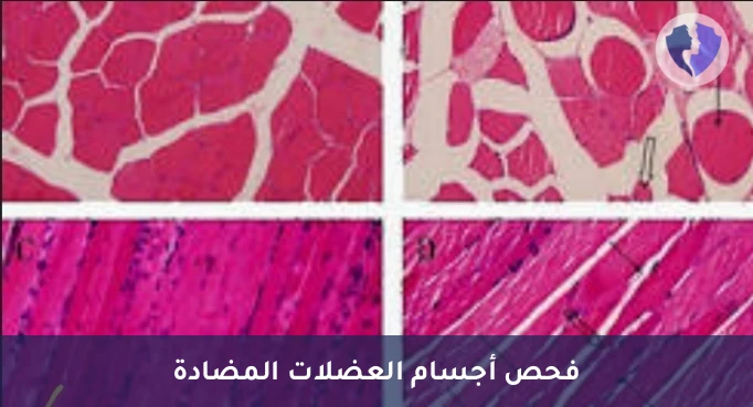 فحص أجسام مضادات العضلات - تحليل الأجسام المضادة للعضلات الهيكلية (Skeletal Muscle ABS)