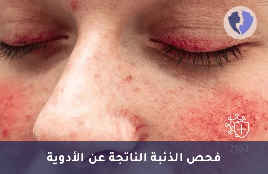 تشخيص الذئبة الناتجة عن الأدوية - تحليل الأجسام المضادة للهيستون (Anti Histone Abs)