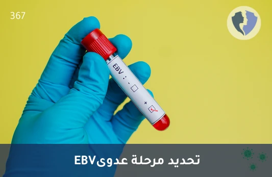 كشف عدوى إبشتاين-بار النشطة - تحليل الأجسام المضادة لمستضد نواة فيروس إبشتاين-بار النوع م (EBV-NA IgM)