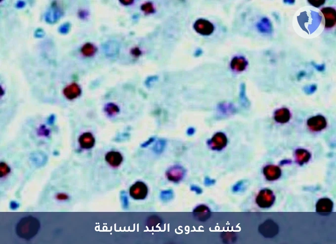 فحص الأجسام المضادة لنواة الكبد - تحليل الأجسام المضادة لنواة فيروس التهاب الكبد ب (HBc IgG)