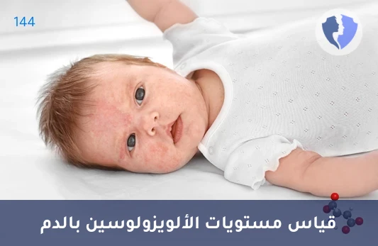 فحص توازن الأحماض الأمينية - تحليل الألويزولوسين (Alloisoleucine)