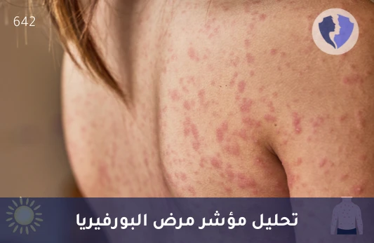 فحص البورفوبيلينوجين الدقيق - تحليل البورفوبيلينوجين (Porphobilinogen) (LC-MS/MS)