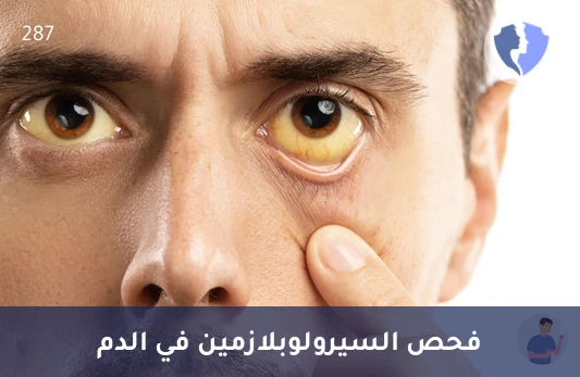 فحص مستويات السيرولوبلازمين - تحليل السيرولوبلازمين في المصل (Ceruloplasmin)