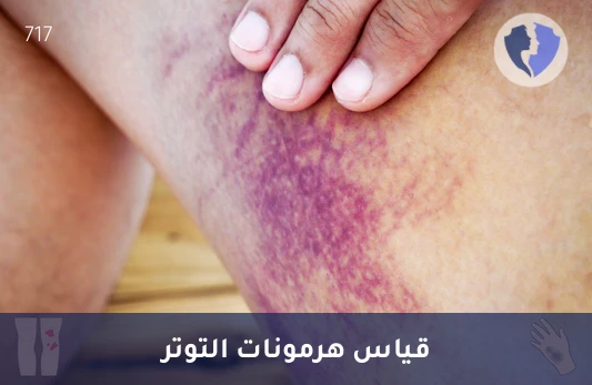 فحص هرمون التوتر (الكورتيزول) - تحليل الكورتيزول الكلي (Total Cortisol)