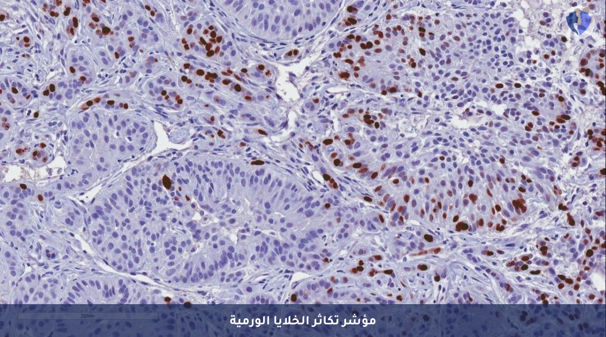 قياس معدل نمو ونشاط الأورام - تحليل الكيمياء النسيجية المناعية (KI-67)