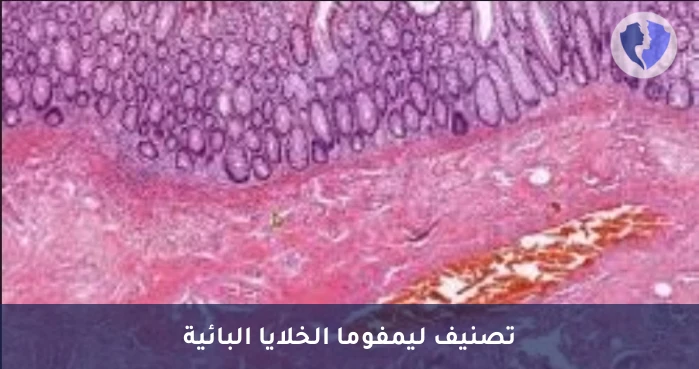 فحص سرطان الغدد الليمفاوية - تحليل الكيمياء النسيجية المناعية لبروتين (CD5)