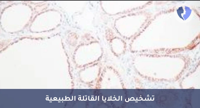 تشخيص أورام الخلايا القاتلة - تحليل الكيمياء النسيجية المناعية لبروتين (CD56)