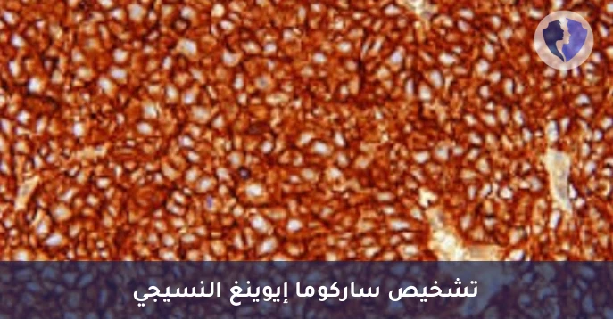 تشخيص أورام العظام والأنسجة - تحليل الكيمياء النسيجية المناعية لبروتين (CD99)