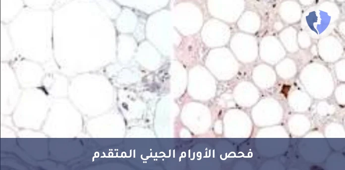 فحص أورام الأنسجة الدهنية - تحليل الكيمياء النسيجية المناعية لبروتين (CDK4)