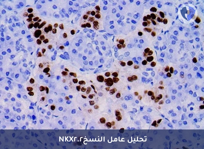 تشخيص أورام العظام والأنسجة - تحليل الكيمياء النسيجية المناعية لبروتين (NKX2.2)