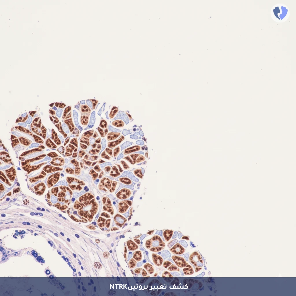 العلاج الموجه للسرطانات النادرة - تحليل الكيمياء النسيجية المناعية لبروتين (NTRK)