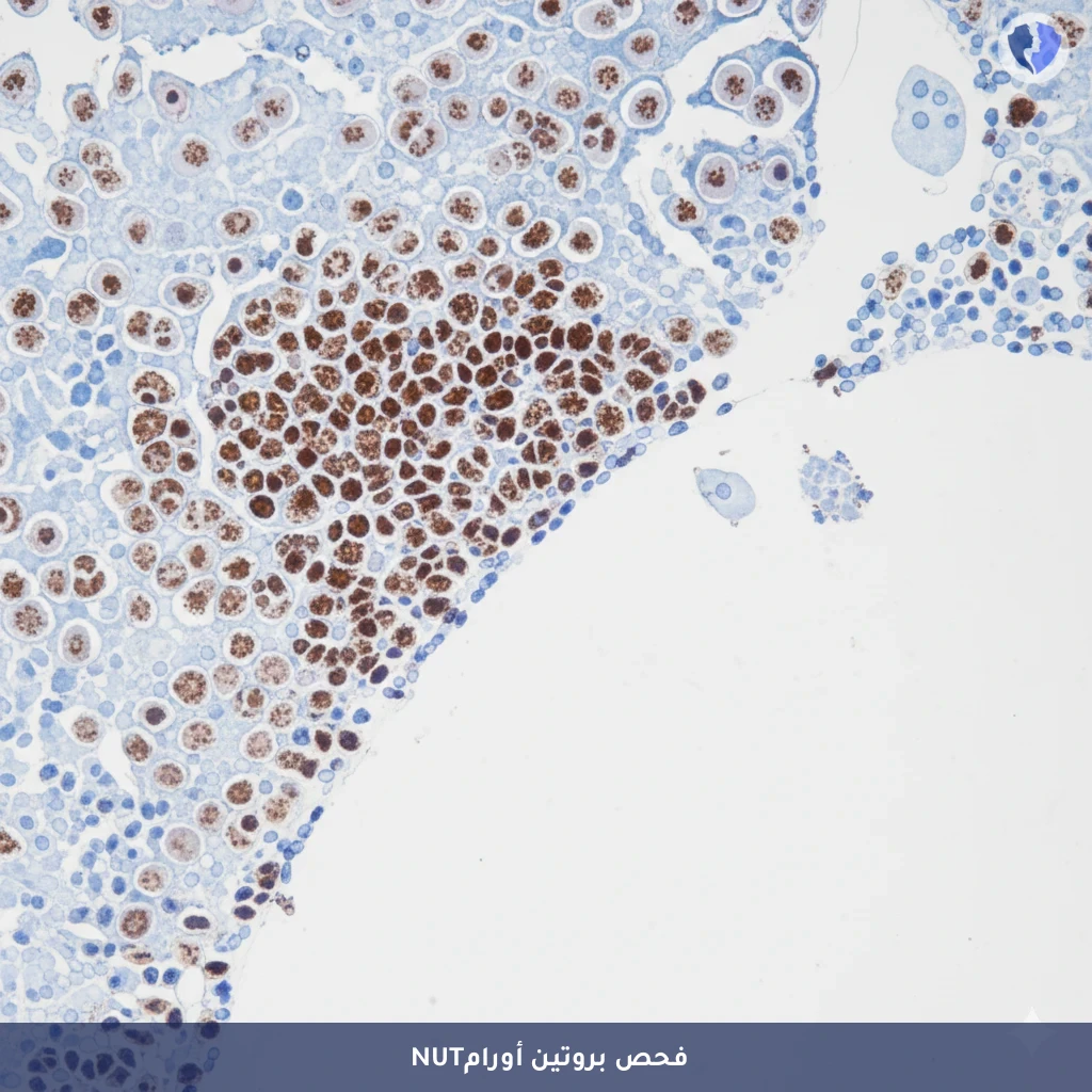 تشخيص سرطان NUT الشرس - تحليل الكيمياء النسيجية المناعية لبروتين (NUT)