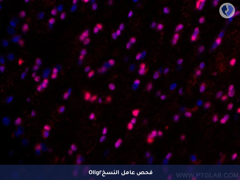 تصنيف أورام الدماغ الدبقية - تحليل الكيمياء النسيجية المناعية لبروتين (Olig2)