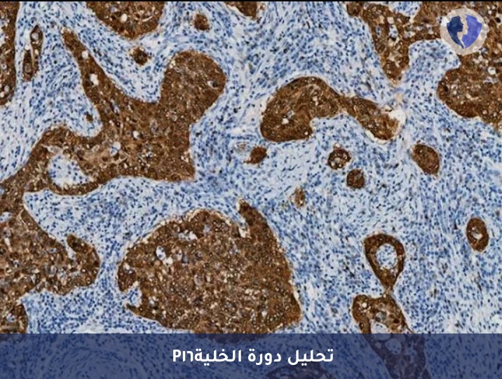 الكشف عن فيروس الورم الحليمي - تحليل الكيمياء النسيجية المناعية لبروتين (P16)