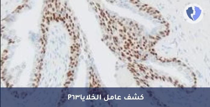تمييز أنواع سرطان الرئة والمسالك - تحليل الكيمياء النسيجية المناعية لبروتين (P63)