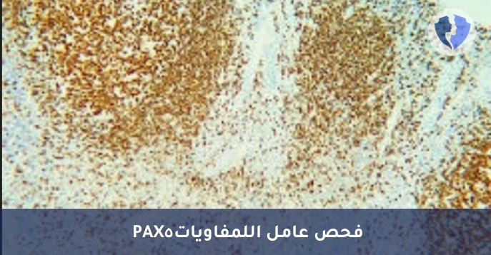فحص دلالات سرطان الليمفوما - تحليل الكيمياء النسيجية المناعية لبروتين (PAX5)