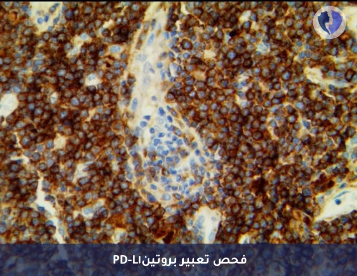 فحص استجابة العلاج المناعي - تحليل الكيمياء النسيجية المناعية لبروتين (PD-L1)
