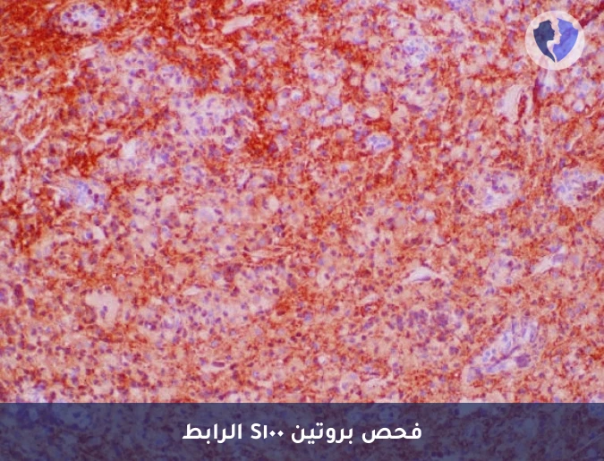 كشف أورام الجلد والأعصاب - تحليل الكيمياء النسيجية المناعية لبروتين (S100)