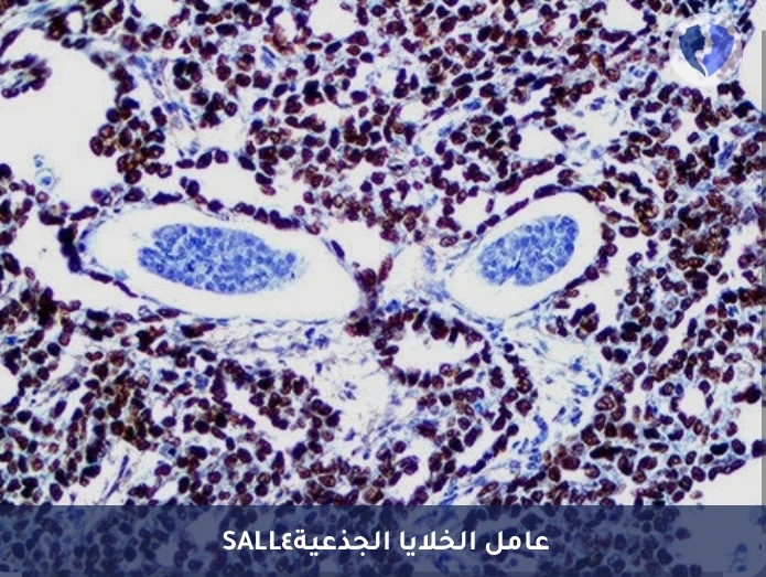 تشخيص أورام الخلايا الجرثومية - تحليل الكيمياء النسيجية المناعية لبروتين (SALL4)