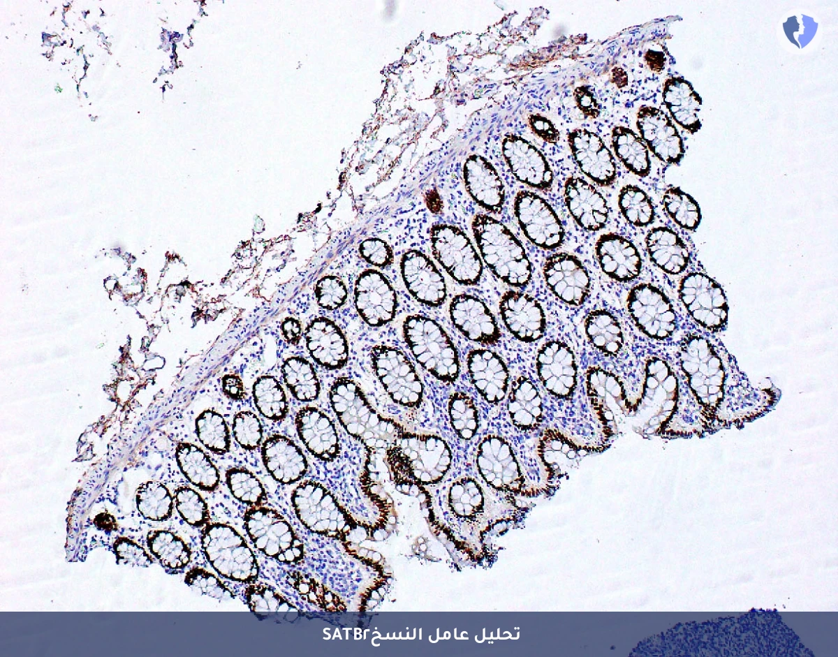 تحديد مصدر سرطان القولون - تحليل الكيمياء النسيجية المناعية لبروتين (SATB2)