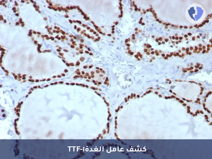 تحديد مصدر أورام الرئة - تحليل الكيمياء النسيجية المناعية لبروتين (TTF-1)