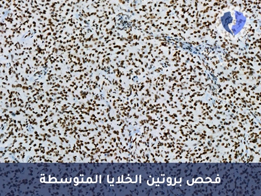 فحص Calretinin لتشخيص الميزوثيليوما - تحليل الكيمياء النسيجية المناعية لبروتين الكالريتينين (Calretinin)