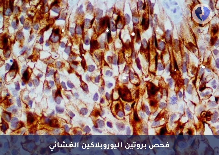 كشف أورام المسالك البولية - تحليل الكيمياء النسيجية المناعية لبروتين اليوروبلاكين (Uroplakin)