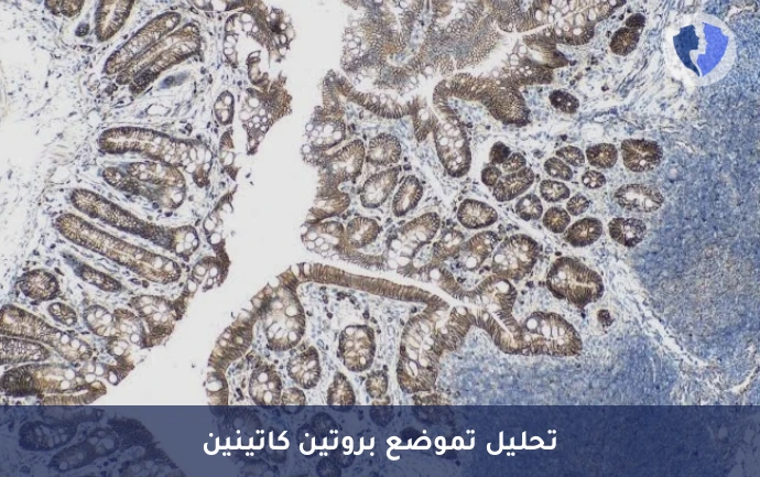 كشف العيوب الجينية بالأورام - تحليل الكيمياء النسيجية المناعية لبروتين بيتا كاتينين (β-Catenin)