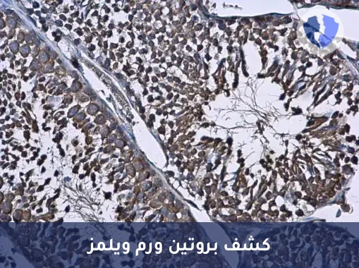 تشخيص أورام المبيض والكلى - تحليل الكيمياء النسيجية المناعية لبروتين ورم ويلمز (WT1)