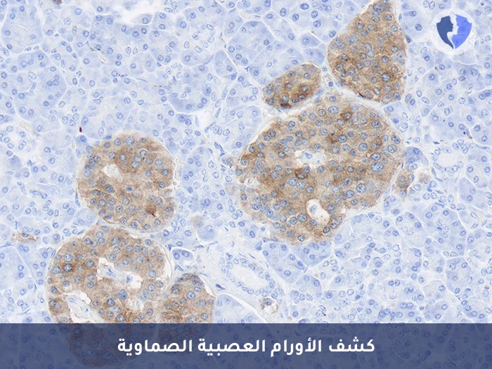 تشخيص أورام الغدد الصماء - تحليل الكيمياء النسيجية المناعية للسينابتوفيزين (Synaptophysin)