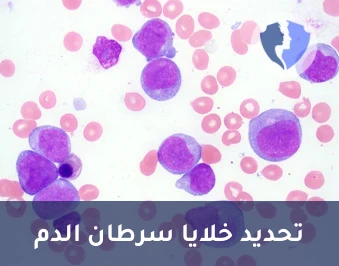 تشخيص أورام الدم والليمفا - تحليل النمط الظاهري لسرطان الدم والليمفوما (Leukemia/Lymphoma Phenotyping)