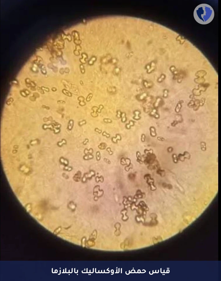 فحص مستوى الأوكسالات في الدم - تحليل حمض الأوكساليك في البلازما (Oxalate)