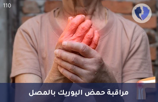 فحص حمض اليوريك للوقاية من النقرس - تحليل حمض اليوريك في المصل (Uric Acid)