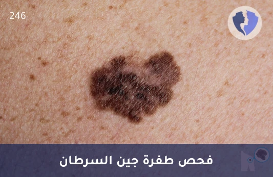 فحص طفرة جين BRAF - تحليل طفرة جين (BRAF)