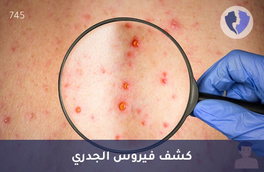 الكشف الدقيق عن فيروس الجدري - تحليل فيروس الجدري المائي بتقنية (PCR)