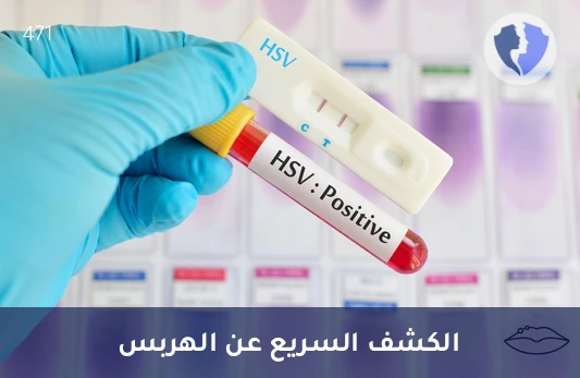 فحص فيروس الهربس البسيط - تحليل فيروس الهربس البسيط النوع 1 و 2 (HSV 1 & 2) بتقنية (PCR)