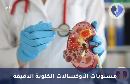 فحص حصوات الكلى والمسالك - تحليل كمي للأوكسالات (Oxalate)