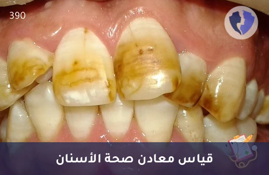 تحليل مستوى الفلورايد في البلازما