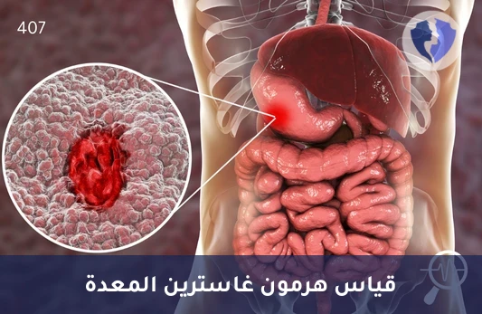 فحص هرمون الجاسترين للهضم - تحليل هرمون الغاسترين (Gastrin)
