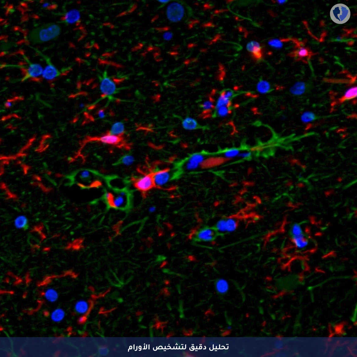 تصنيف دقيق وتقييم المخاطر - تحليل واستشارة الكيمياء النسيجية المناعية (4 Markers) (IHC)