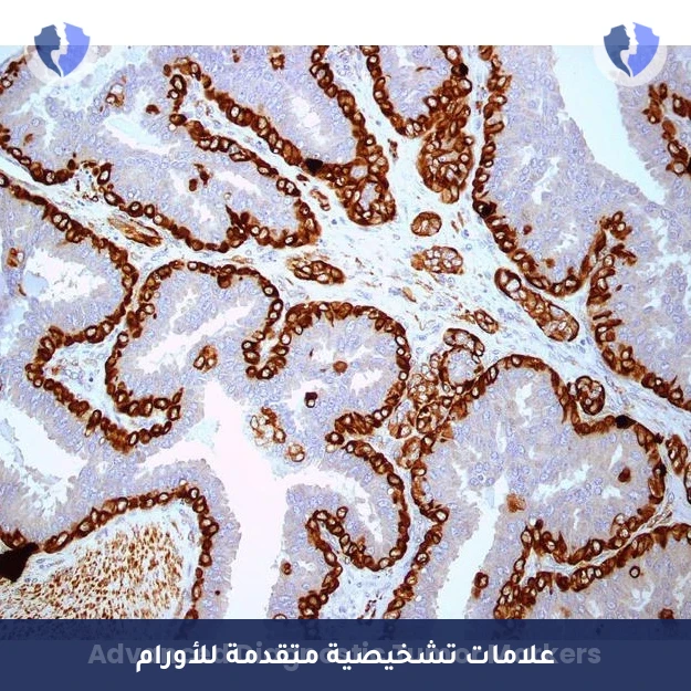 تشخيص تفريقي وتقييم بيئي - تحليل واستشارة الكيمياء النسيجية المناعية (6 Markers) (IHC)