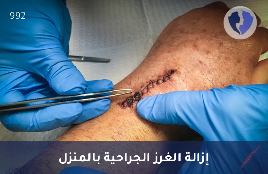 فك الغرز الجراحية بالمنزل - تمريض لإزالة الغرز الجراحية بالمنزل