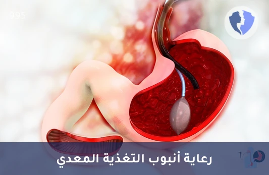 العناية بأنبوب التغذية المعدي - تمريض للعناية بأنبوب التغذية المعدي (PEG) بالمنزل
