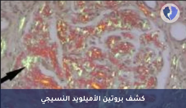 صبغة كونغو ريد للأميلويد - صبغة كونغو الحمراء النسيجية (Congo Red)