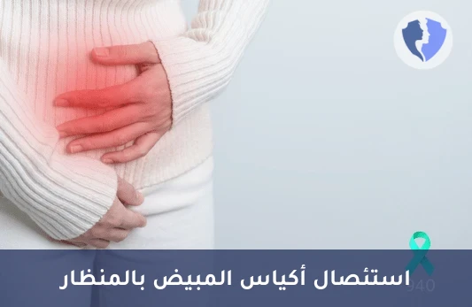 استئصال أكياس المبيضين بالمنظار - عملية استئصال أكياس المبيض بالمنظار (الجهتين)