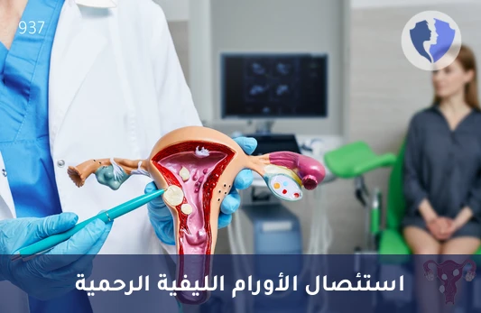استئصال الألياف الرحمية - عملية استئصال الأورام الليفية الرحمية (Myomectomy)